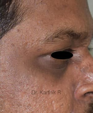 Under Eye Fat Fill