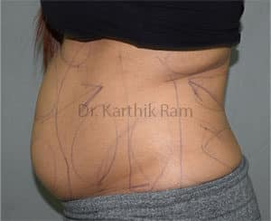 Liposuction Tummy and Back