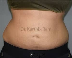 Liposuction Tummy and Back