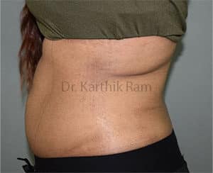 Liposuction Tummy and Back