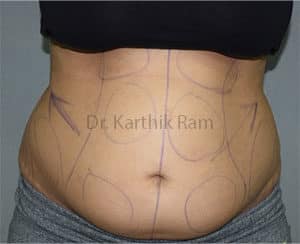 Liposuction Tummy and Back