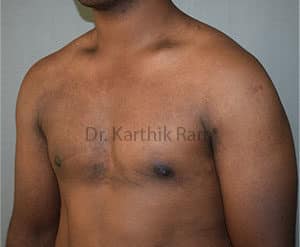 Gynecomastia (Puffy Nipples/ Male Chest Correction)
