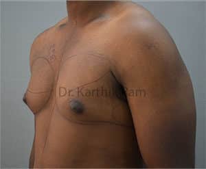 Gynecomastia (Puffy Nipples/ Male Chest Correction)