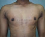 Gynecomastia (Puffy Nipples/ Male Chest Correction)