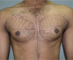 Gynecomastia (Puffy Nipples/ Male Chest Correction)