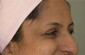 Botox
