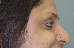 Botox