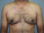 Gynecomastia (Puffy Nipples/ Male Chest Correction)