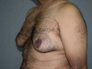 Gynecomastia (Puffy Nipples/ Male Chest Correction)
