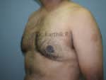 Gynecomastia (Puffy Nipples/ Male Chest Correction)