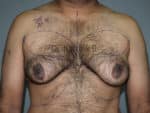 Gynecomastia (Puffy Nipples/ Male Chest Correction)