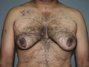 Gynecomastia (Puffy Nipples/ Male Chest Correction)