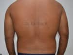 Liposuction Tummy and Back