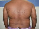 Liposuction Tummy and Back