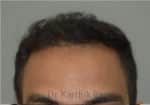 Hair Transplantation
