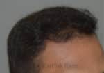 Hair Transplantation