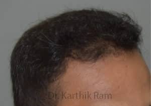 Hair Transplantation