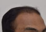 Hair Transplantation