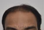 Hair Transplantation