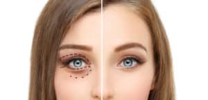 Lower Blepharoplasty.upper Blepharoplasty.marking The Face.perforation Lines On Females Face, Plastic Surgery Concept. Istock 950787480 E1557767407524