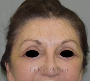 Blepharoplasty