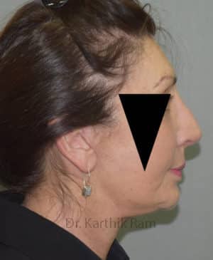 Rhinoplasty (Nose Corrections)