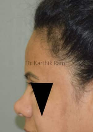 Rhinoplasty (Nose Corrections)