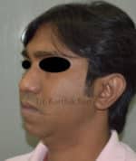 Chin Implant