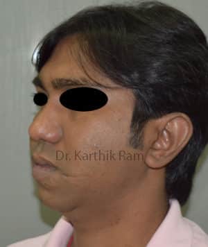 Chin Implant