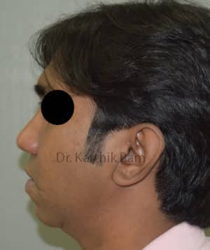 Chin Implant