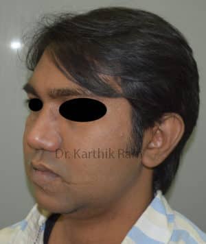 Chin Implant