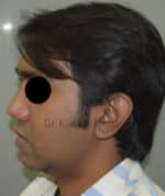 Chin Implant