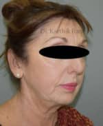 Chin Implant