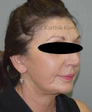 Chin Implant