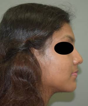 Buccal Fat Removal