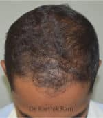 Dermaroller scalp