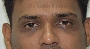Dermal Fillers