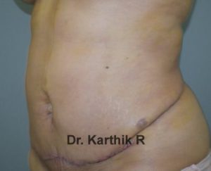 Mini Tummy Tuck (Panniculectomy)