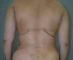 Liposuction Tummy and Back