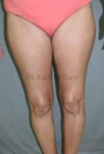 Liposuction Thighs