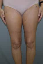 Liposuction Thighs