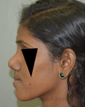 Rhinoplasty (Nose Corrections)