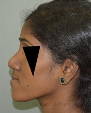 Rhinoplasty (Nose Corrections)