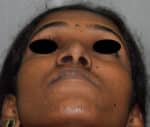 Rhinoplasty (Nose Corrections)