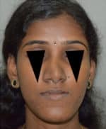Rhinoplasty (Nose Corrections)