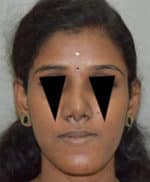 Rhinoplasty (Nose Corrections)