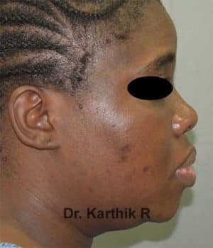 Lip Correction