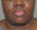 Double Chin Liposuction