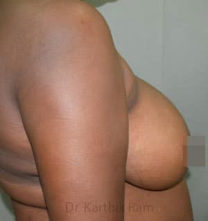 Breast Reduction and Breast Lift