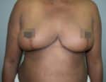 Breast Reduction and Breast Lift